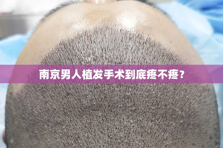 南京男人植发手术到底疼不疼？