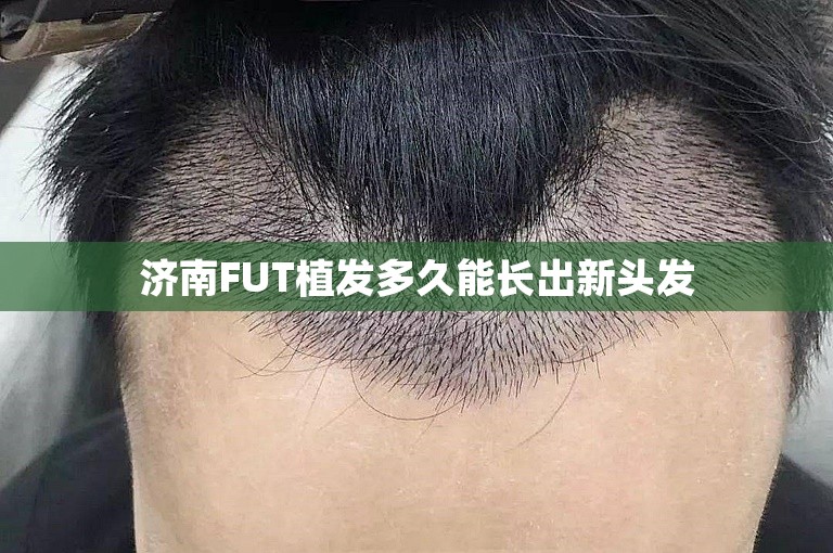 济南FUT植发多久能长出新头发