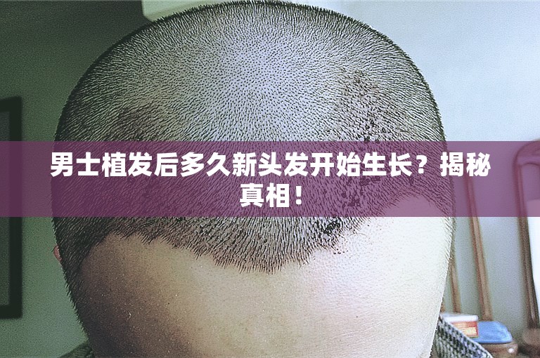 男士植发后多久新头发开始生长？揭秘真相！