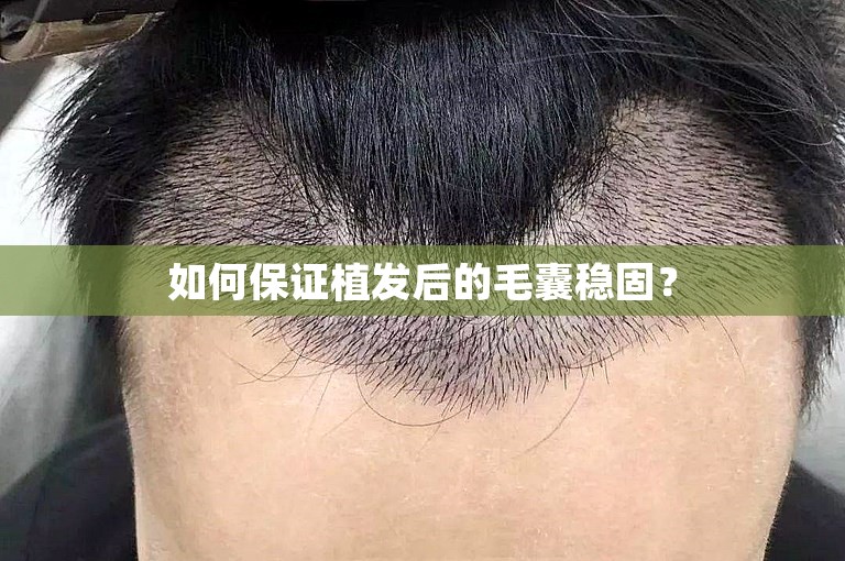 如何保证植发后的毛囊稳固？