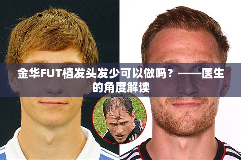 金华FUT植发头发少可以做吗？——医生的角度解读