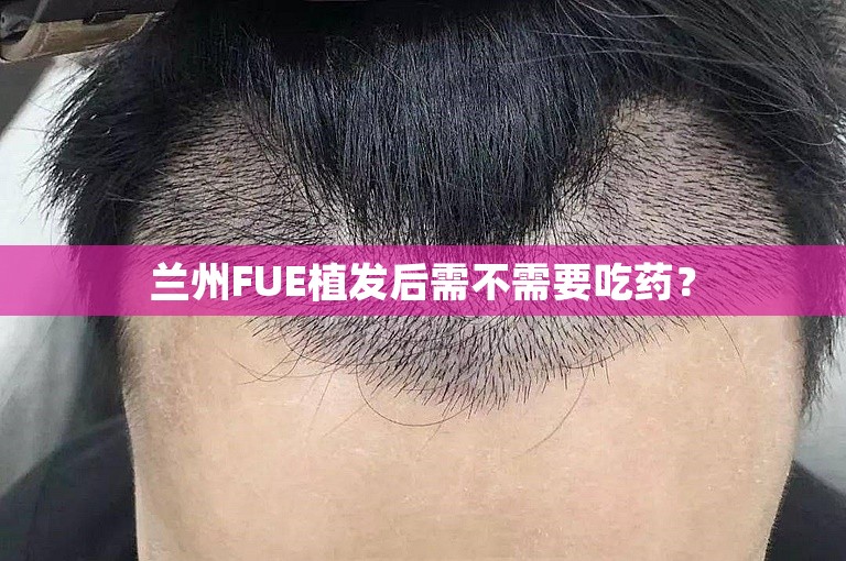 兰州FUE植发后需不需要吃药？