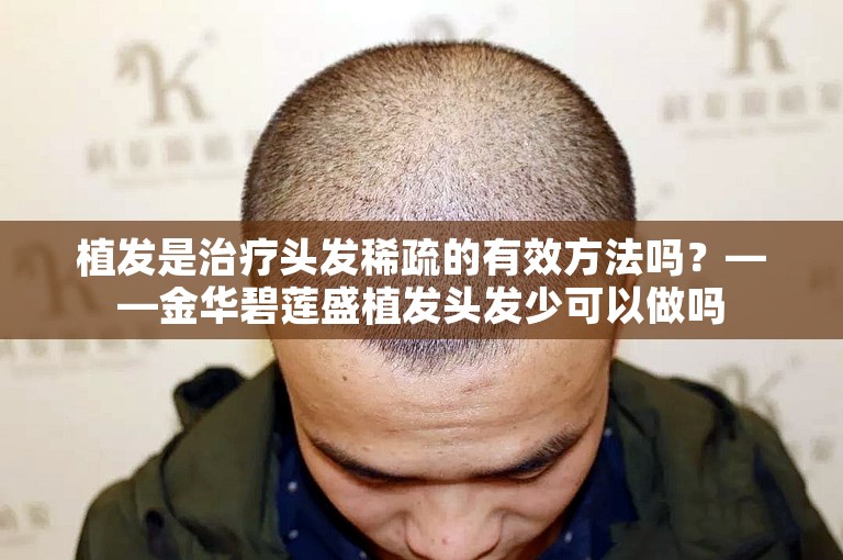 植发是治疗头发稀疏的有效方法吗？——金华碧莲盛植发头发少可以做吗