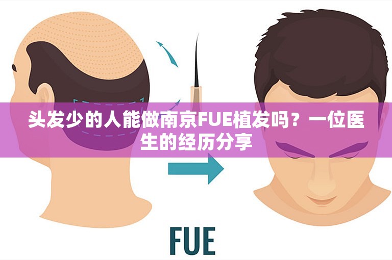 头发少的人能做南京FUE植发吗？一位医生的经历分享