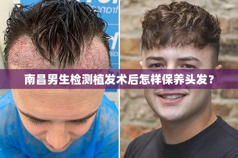 南昌男生检测植发术后怎样保养头发？