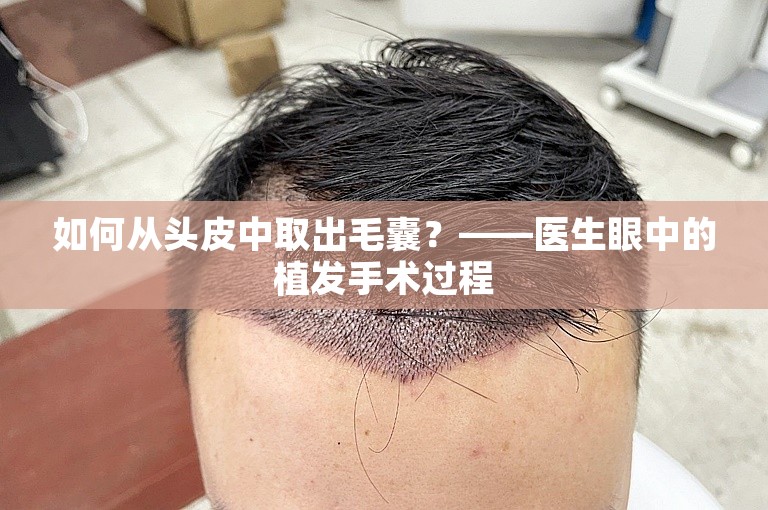 如何从头皮中取出毛囊？——医生眼中的植发手术过程