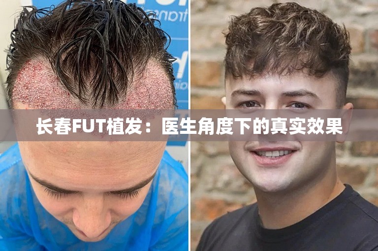 长春FUT植发：医生角度下的真实效果