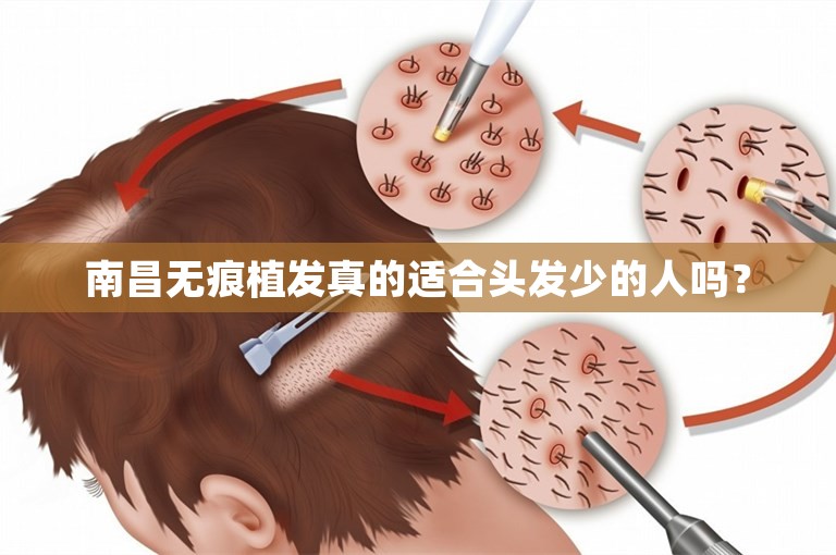 南昌无痕植发真的适合头发少的人吗？