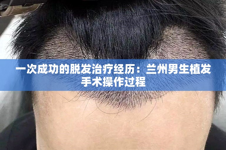 一次成功的脱发治疗经历：兰州男生植发手术操作过程