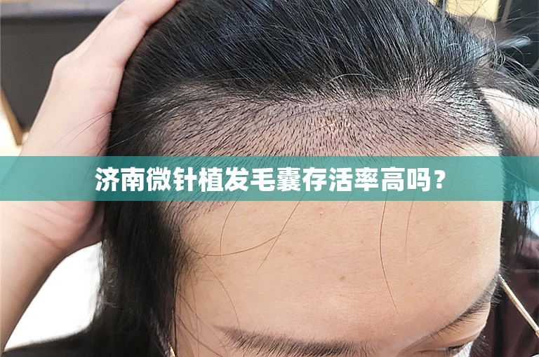 济南微针植发毛囊存活率高吗？