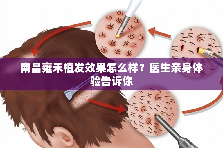 南昌雍禾植发效果怎么样？医生亲身体验告诉你