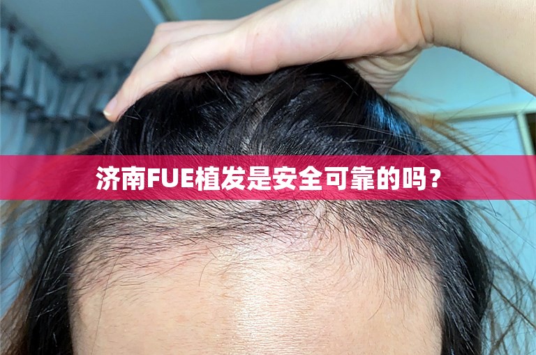 济南FUE植发是安全可靠的吗？