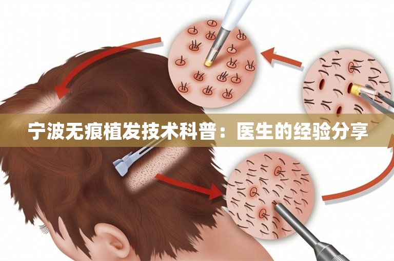 宁波无痕植发技术科普：医生的经验分享