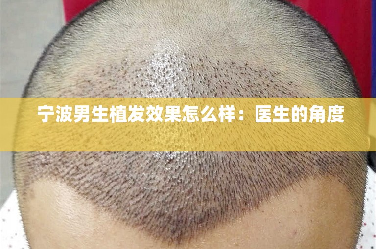  宁波男生植发效果怎么样：医生的角度 