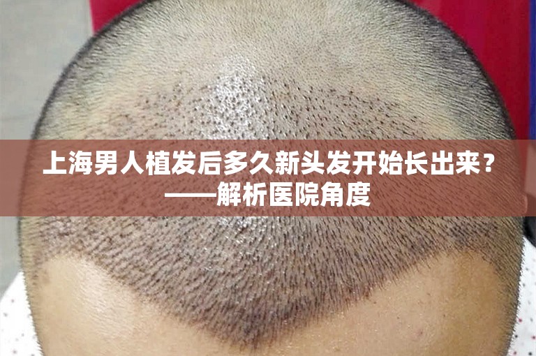 上海男人植发后多久新头发开始长出来？——解析医院角度