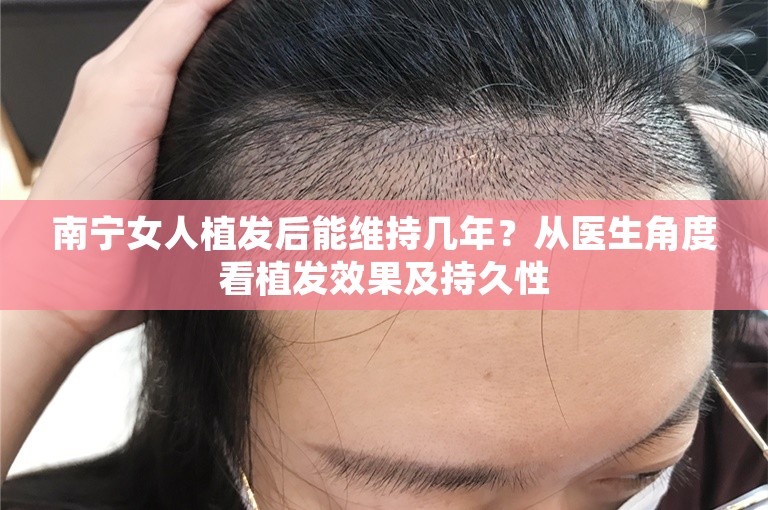 南宁女人植发后能维持几年？从医生角度看植发效果及持久性