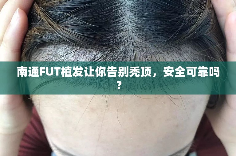 南通FUT植发让你告别秃顶，安全可靠吗？