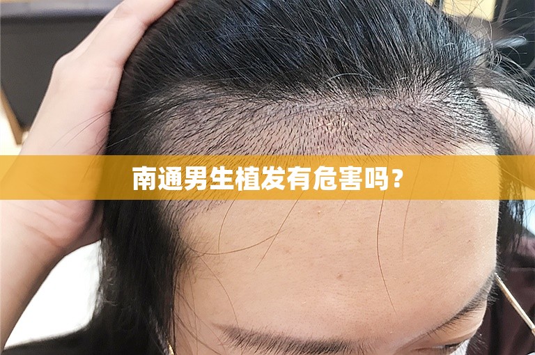 南通男生植发有危害吗？