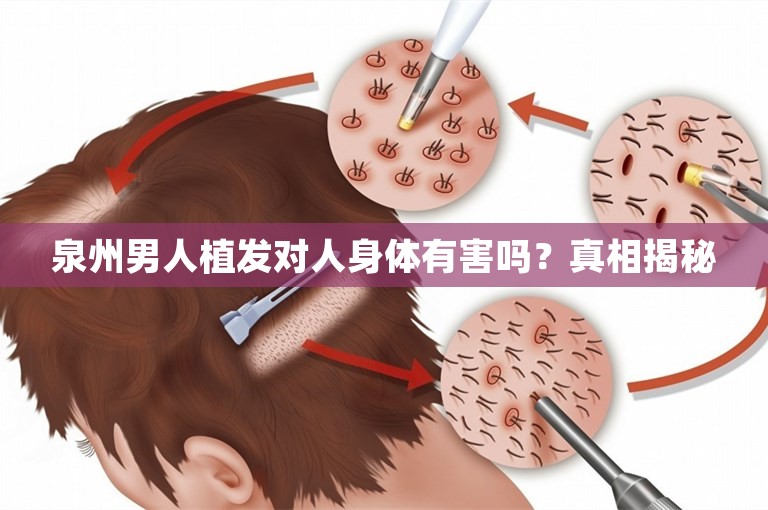 泉州男人植发对人身体有害吗？真相揭秘