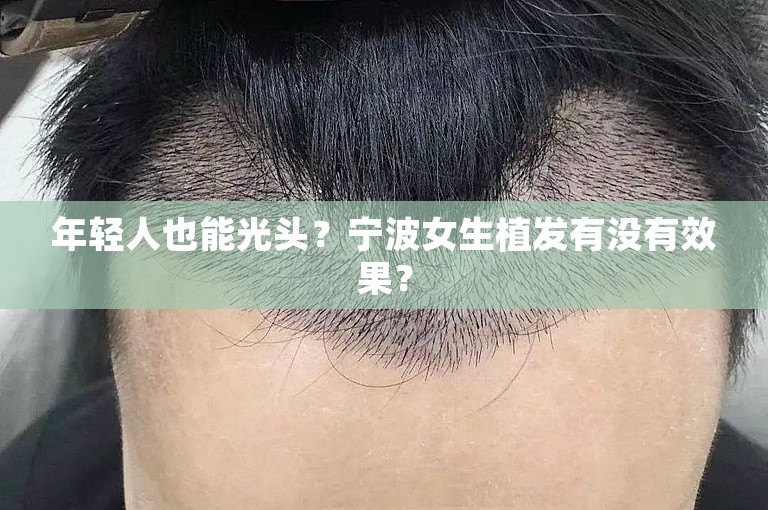 年轻人也能光头？宁波女生植发有没有效果？