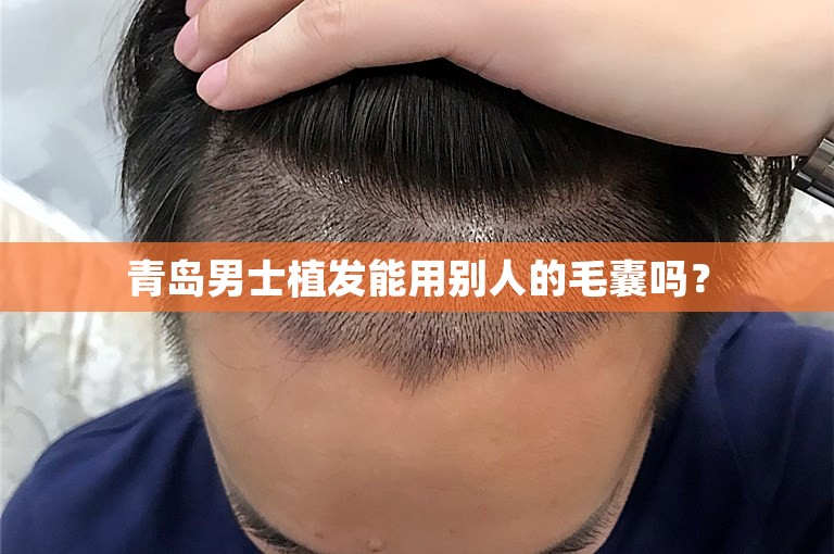 青岛男士植发能用别人的毛囊吗？