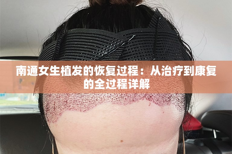 南通女生植发的恢复过程：从治疗到康复的全过程详解