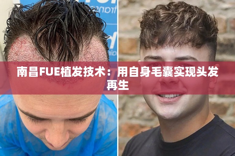 南昌FUE植发技术：用自身毛囊实现头发再生