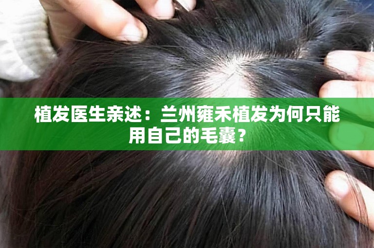 植发医生亲述：兰州雍禾植发为何只能用自己的毛囊？