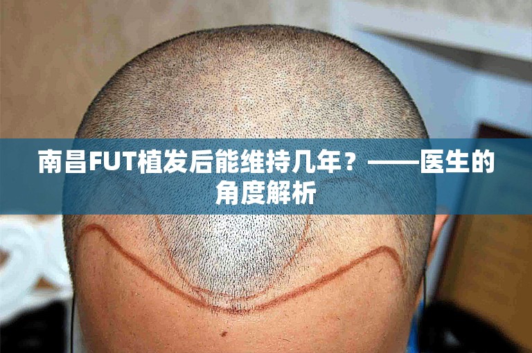 南昌FUT植发后能维持几年？——医生的角度解析