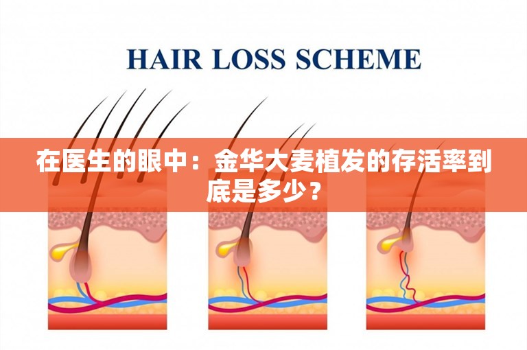 在医生的眼中：金华大麦植发的存活率到底是多少？