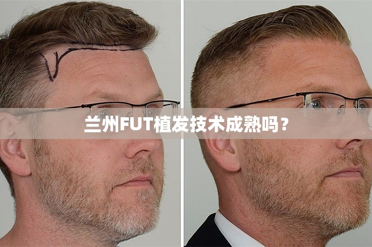 兰州FUT植发技术成熟吗？