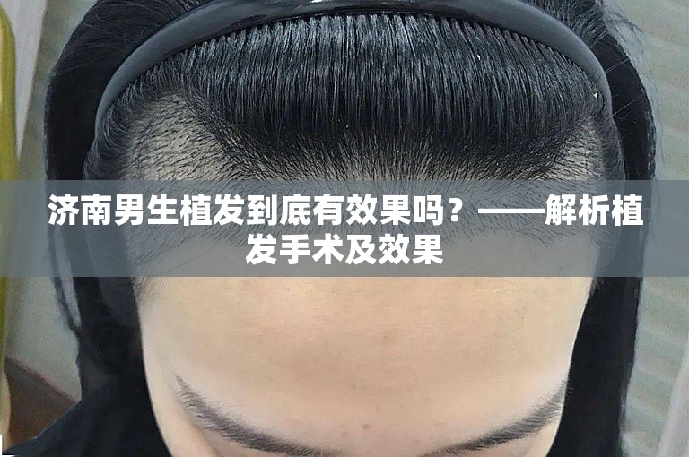 济南男生植发到底有效果吗？——解析植发手术及效果