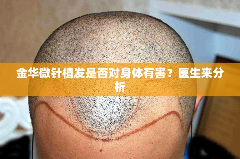 金华微针植发是否对身体有害？医生来分析