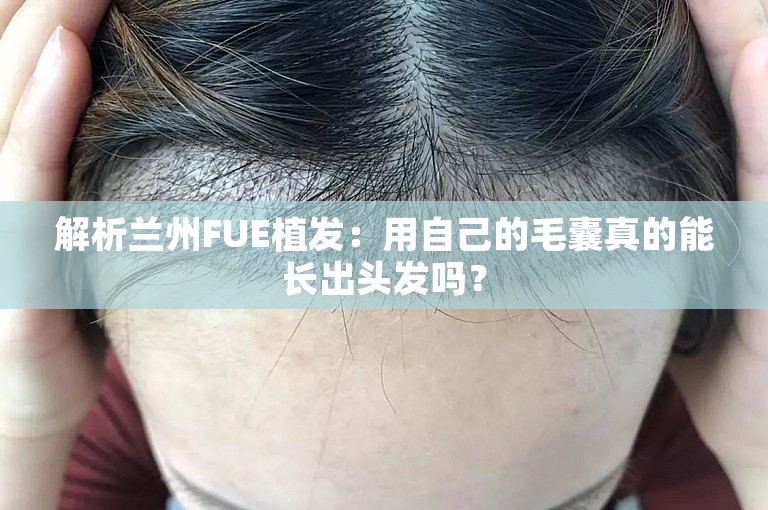 解析兰州FUE植发：用自己的毛囊真的能长出头发吗？