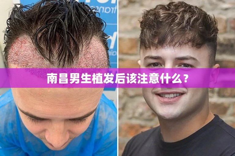 南昌男生植发后该注意什么？