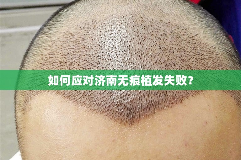 如何应对济南无痕植发失败？