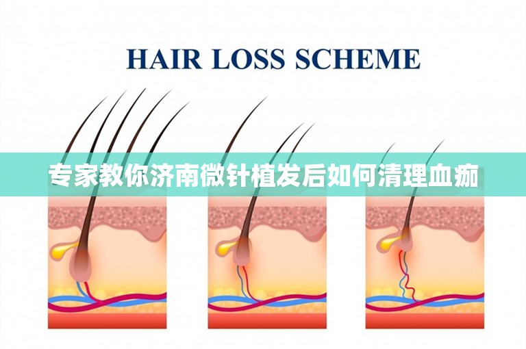 专家教你济南微针植发后如何清理血痂