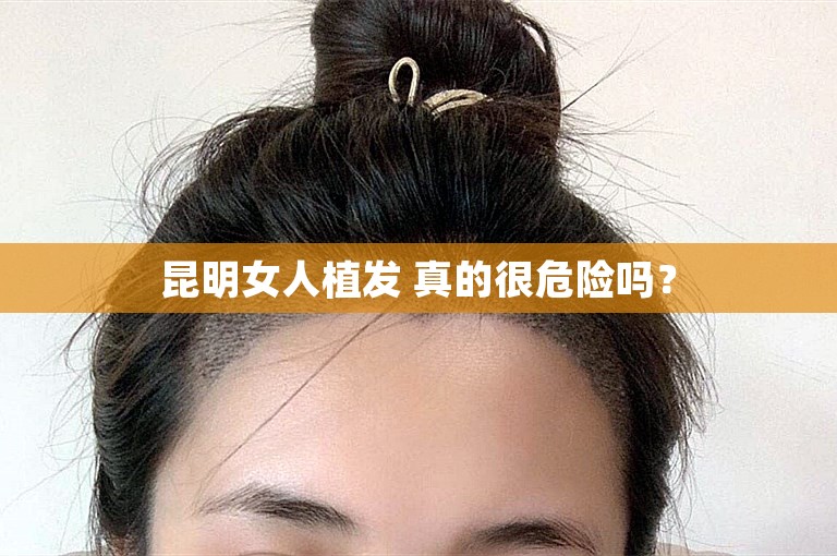 昆明女人植发 真的很危险吗？