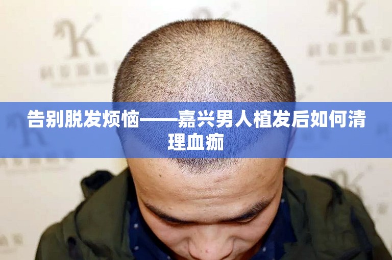 告别脱发烦恼——嘉兴男人植发后如何清理血痂