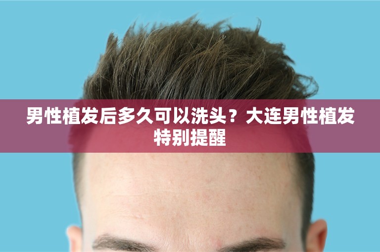 男性植发后多久可以洗头？大连男性植发特别提醒