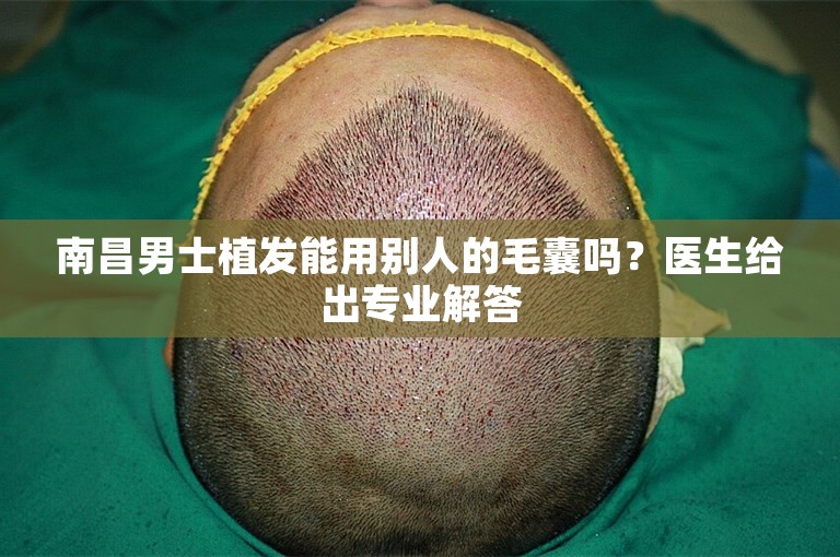 南昌男士植发能用别人的毛囊吗？医生给出专业解答