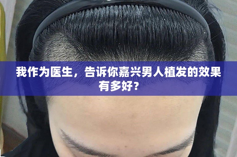 我作为医生，告诉你嘉兴男人植发的效果有多好？