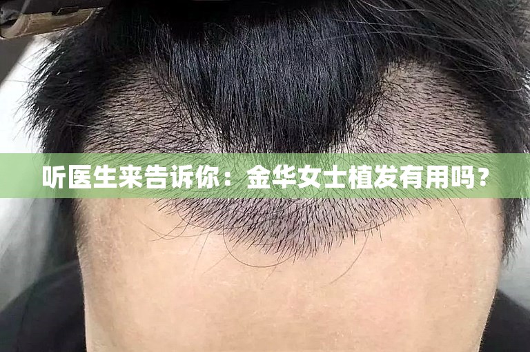 听医生来告诉你：金华女士植发有用吗？