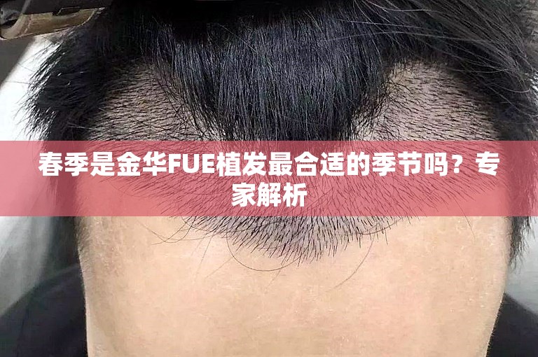 春季是金华FUE植发最合适的季节吗？专家解析