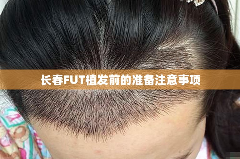 长春FUT植发前的准备注意事项