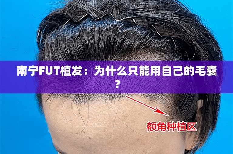 南宁FUT植发：为什么只能用自己的毛囊？