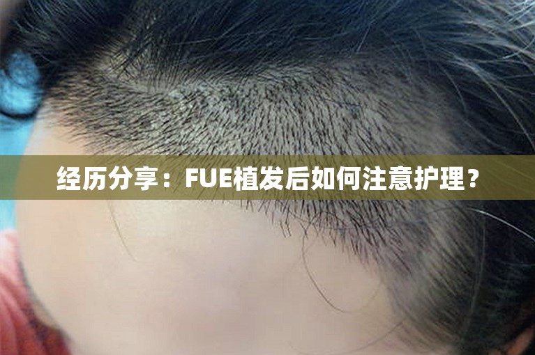 经历分享：FUE植发后如何注意护理？