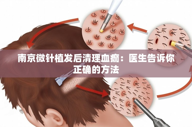 南京微针植发后清理血痂：医生告诉你正确的方法