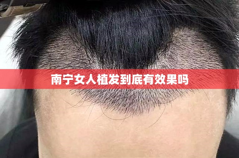 南宁女人植发到底有效果吗