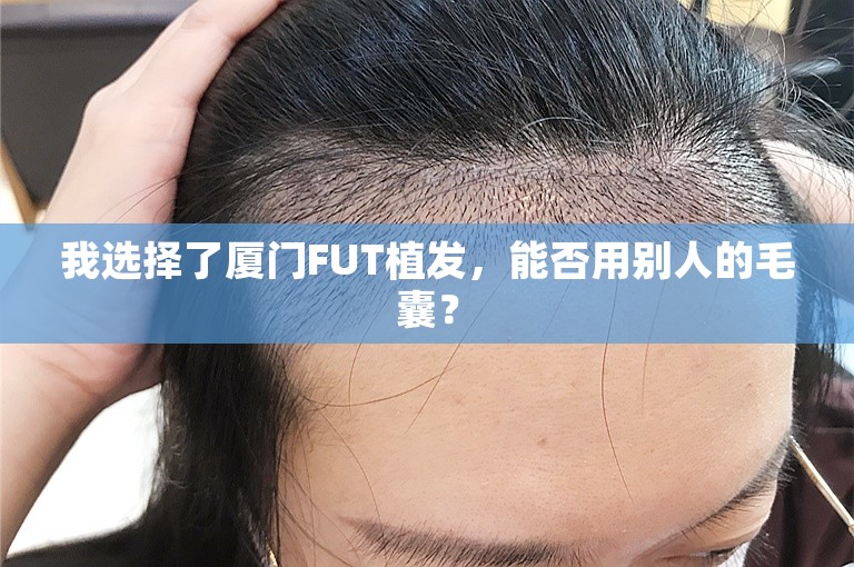 我选择了厦门FUT植发，能否用别人的毛囊？